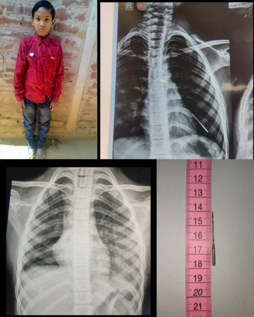AIIMS BHUBANESWAR PEDIATRICS DEPARTMENT DOCTORS SAVE LIFE OF 9-YEAR-OLD BOY BY REMOVING STITCHING NEEDLE FROM LUNGS.