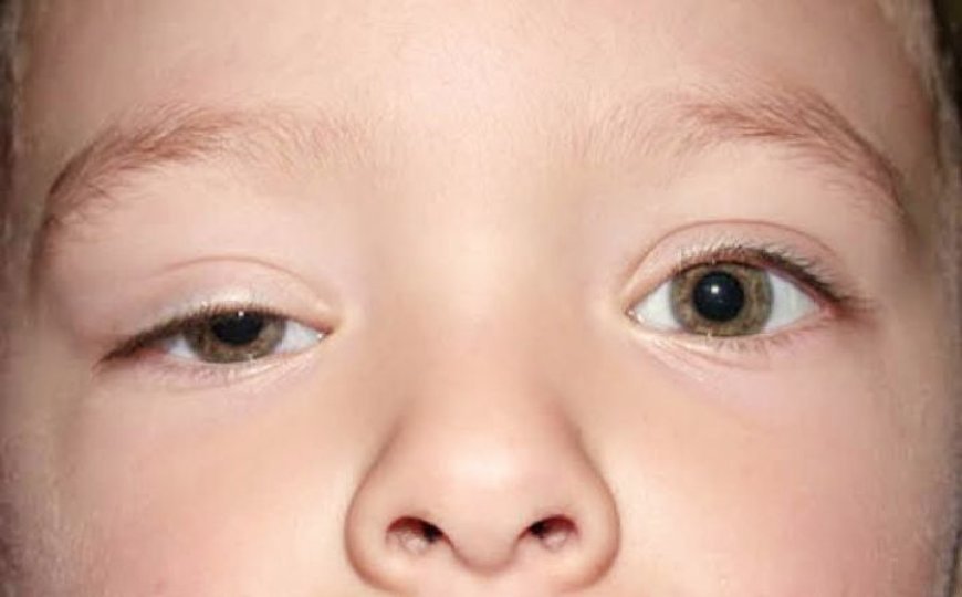 Childhood Ptosis: Causes, myths & treatment solutions